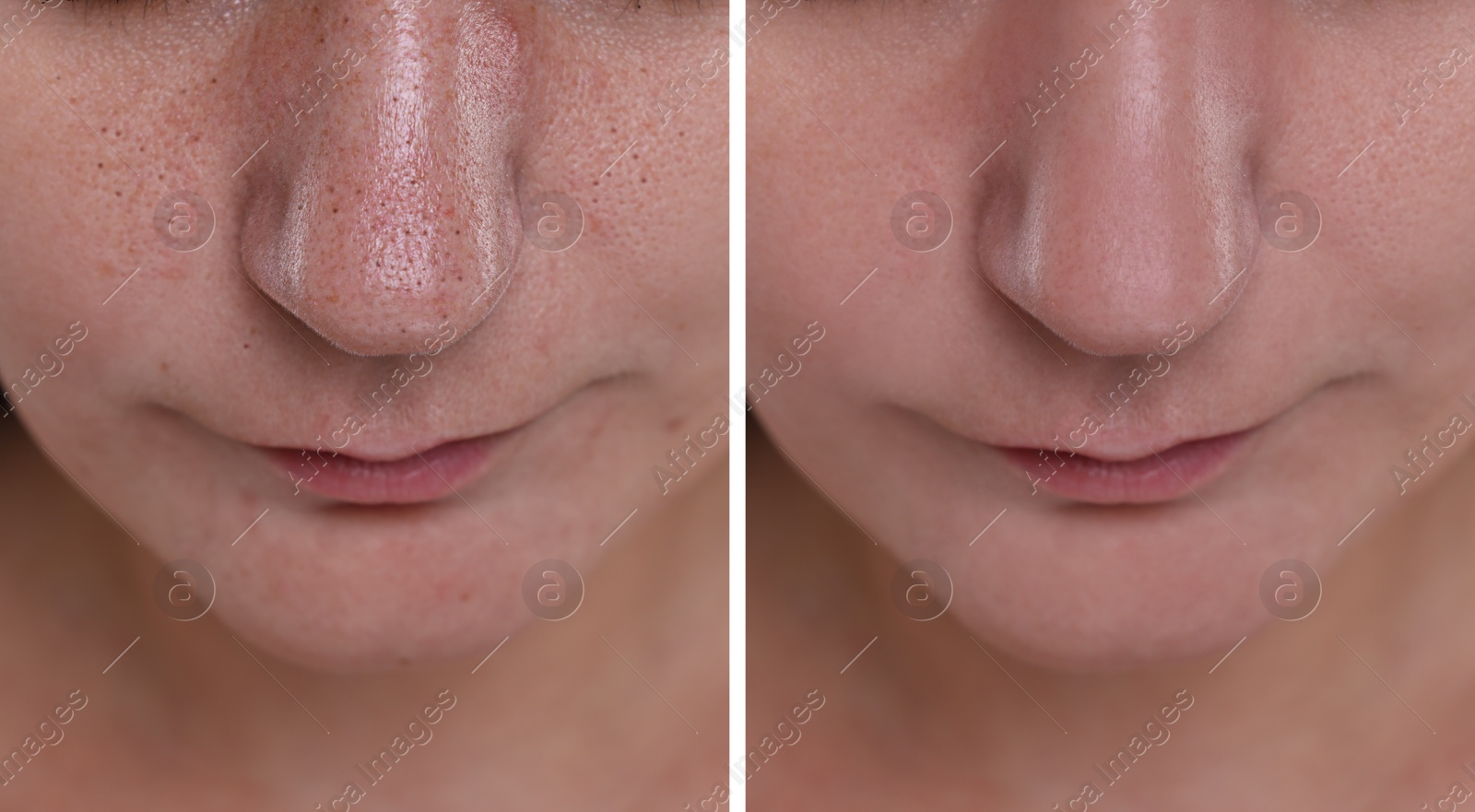 Image of Blackhead treatment, before and after. Collage with photos of woman, closeup view