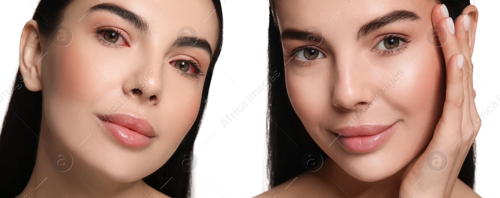 Image of Before and after conjunctivitis treatment. Photos of woman with red and healthy eyes, collage