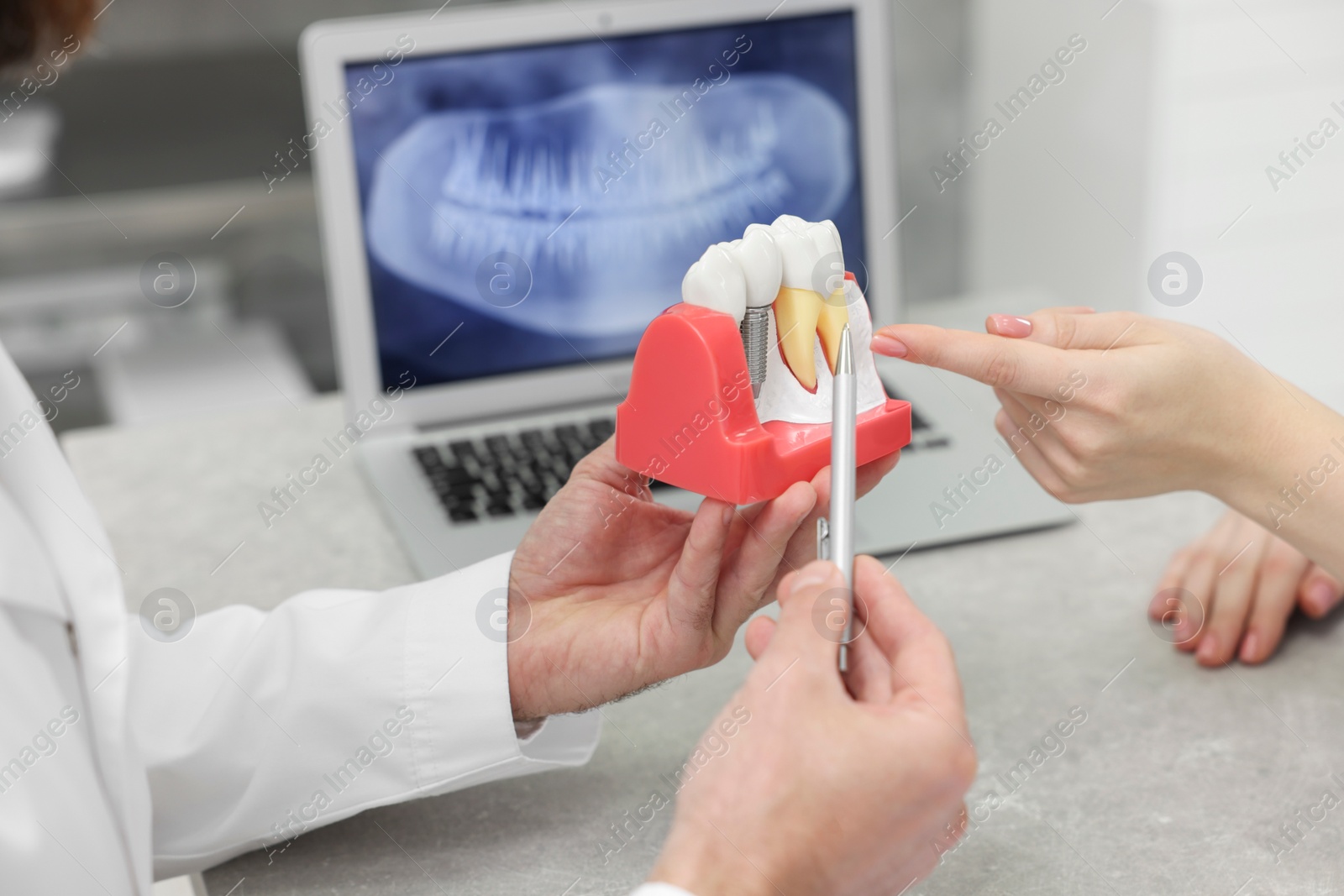 Photo of Doctor showing patient educational model of dental implant in clinic, closeup