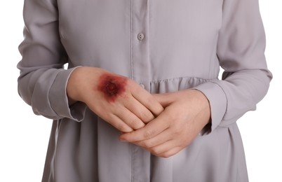 Photo of Woman with burned hand on white background, closeup