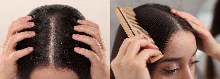 Woman showing hair before and after dandruff treatment on color backgrounds, collage