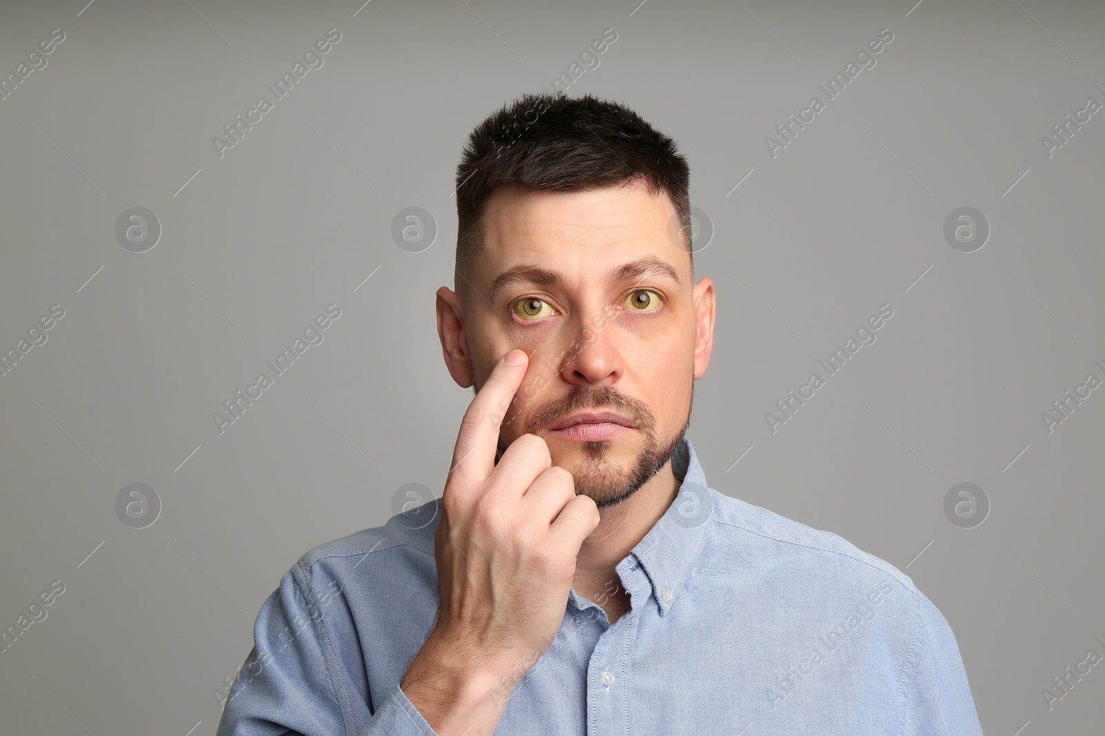 Photo of Man checking his health condition on grey background. Yellow eyes as symptom of problems with liver