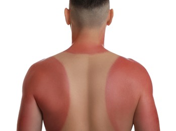 Man with sunburned skin on white background, back view
