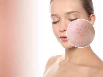 Woman with acne on her face on beige gradient background, space for text. Zoomed area showing problem skin