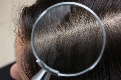 Photo of Closeup of woman with dandruff in her hair, view through magnifying glass