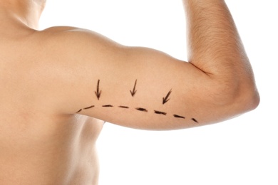 Photo of Young man with marks on arm for cosmetic surgery operation against white background, closeup