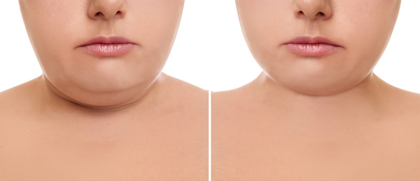 Woman before and after plastic surgery operation on white background, closeup. Double chin problem