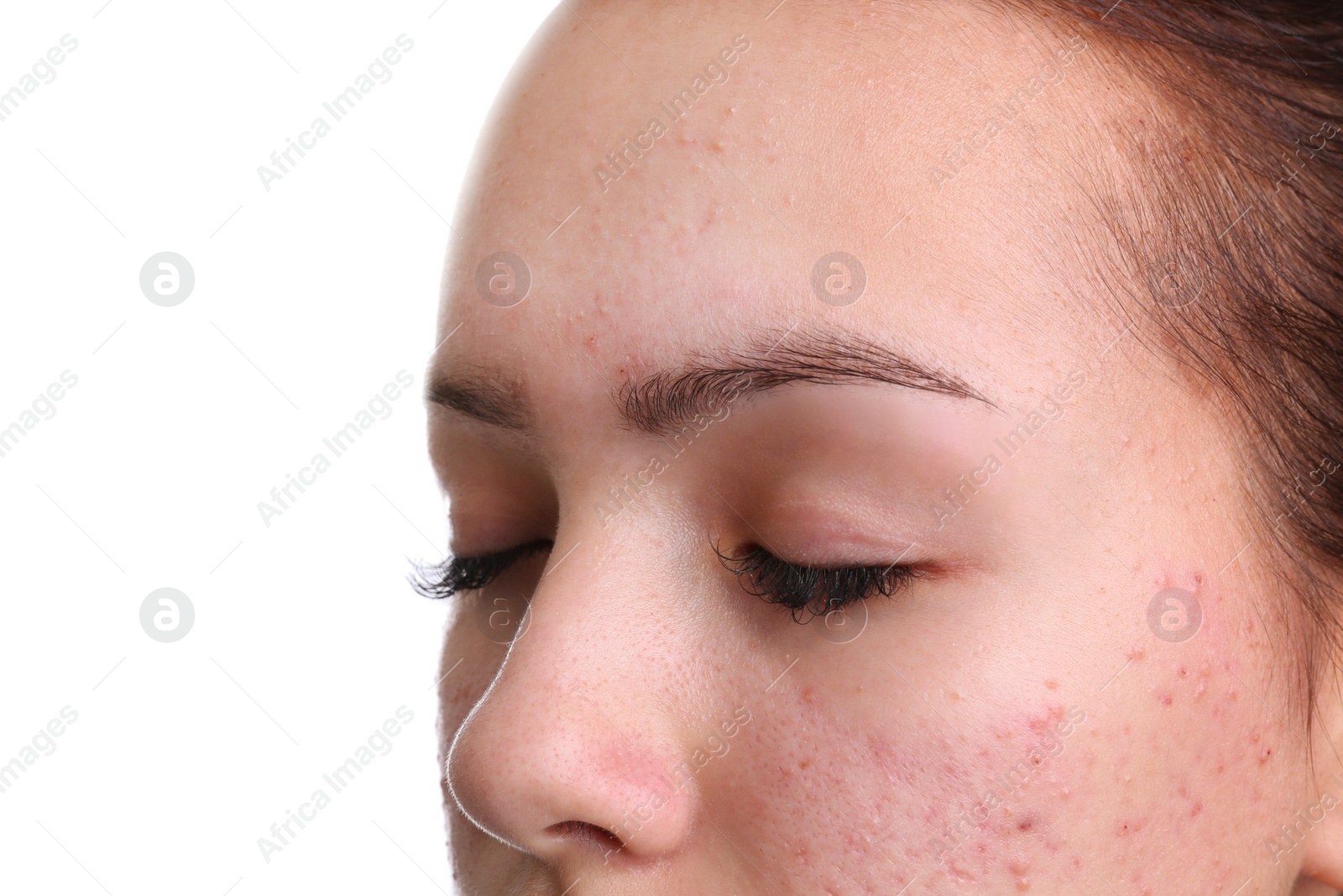 Photo of Teenage girl with acne problem on white background, closeup