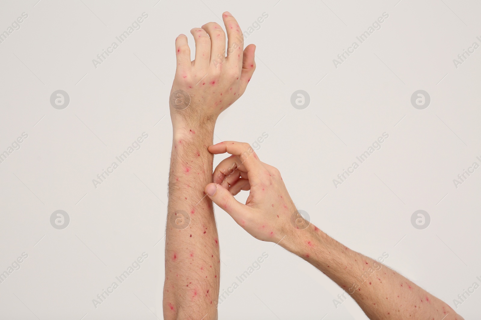 Photo of Man with rash suffering from monkeypox virus on beige background, closeup