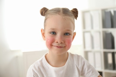 Image of Cute little girl with allergy symptoms on cheeks  at home 
