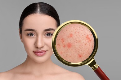 Image of Dermatology. Woman with skin problem on grey background. View through magnifying glass on acne