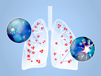 Illustration of  human lungs affected with disease on light blue background