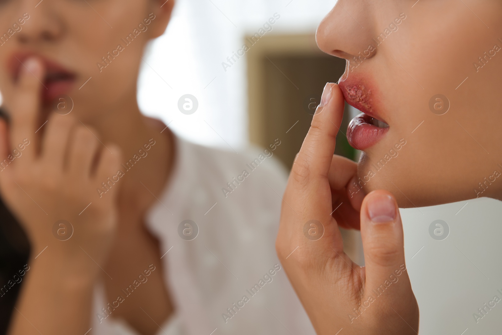 Photo of Woman with herpes touching lips in front of mirror, closeup