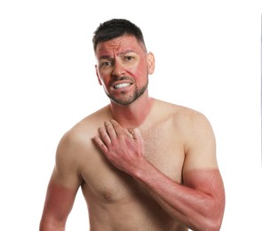 Man with sunburned skin on white background