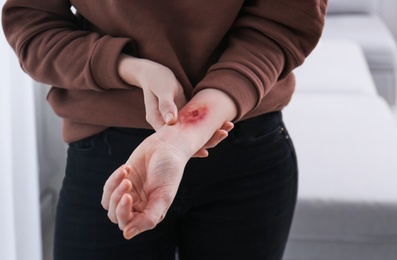 Photo of Woman with burn on her forearm indoors, closeup