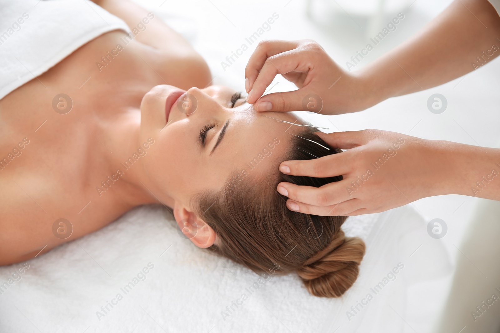 Photo of Young woman undergoing acupuncture treatment in salon