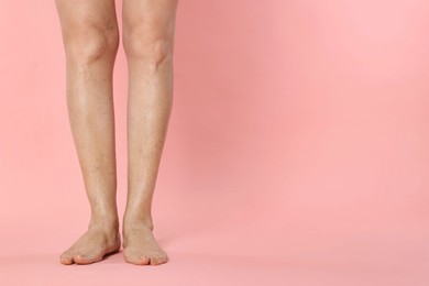 Photo of Closeup view of woman with varicose veins on pink background. Space for text