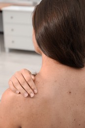 Photo of Closeup of woman`s body with birthmarks indoors, back view