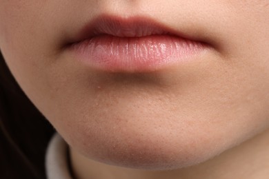 Photo of Young woman with acne problem, closeup view