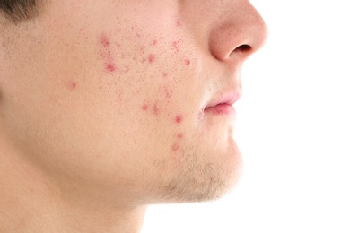 Young man with acne problem on white background