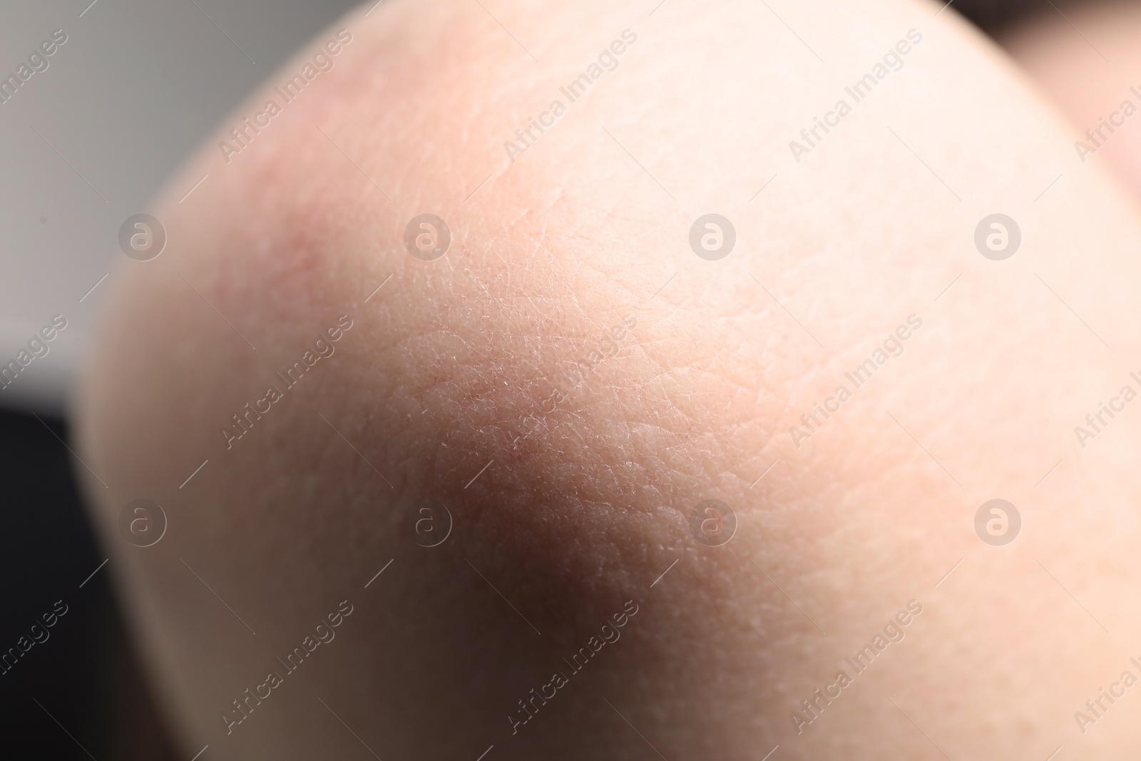 Photo of Woman with dry skin on elbow, closeup