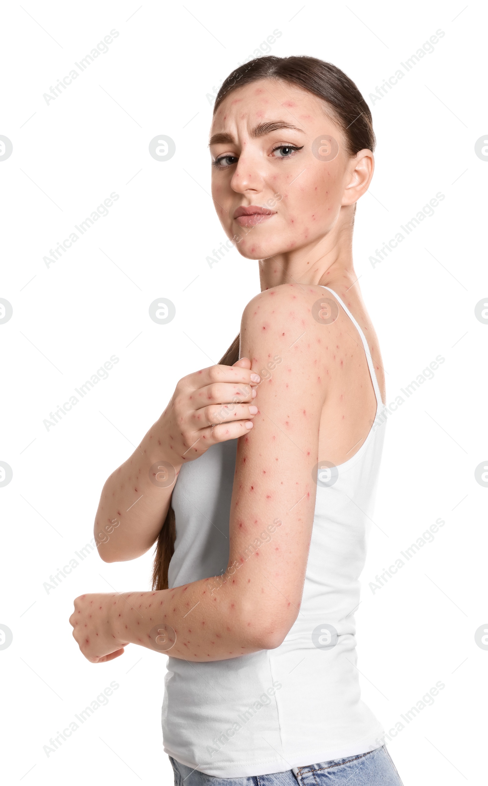 Photo of Woman with rash suffering from monkeypox virus on white background