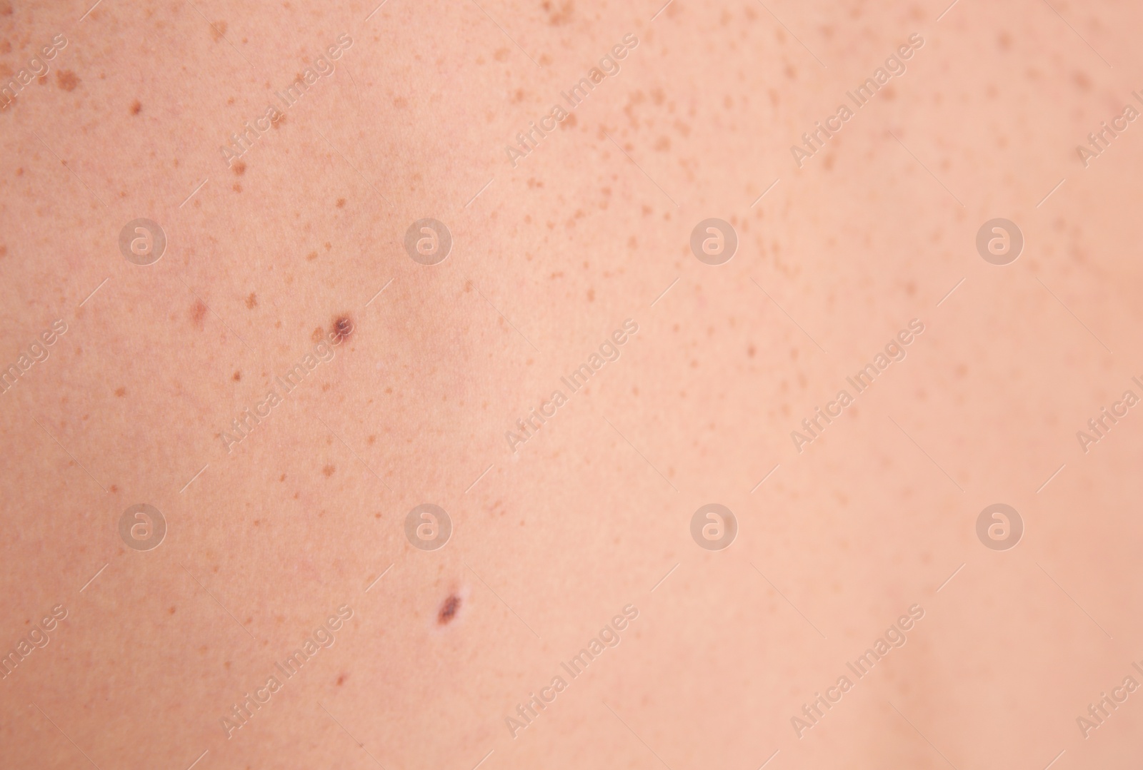 Photo of Person with birthmarks, closeup view. Time to visit dermatologist