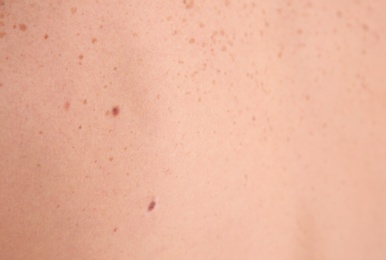 Person with birthmarks, closeup view. Time to visit dermatologist