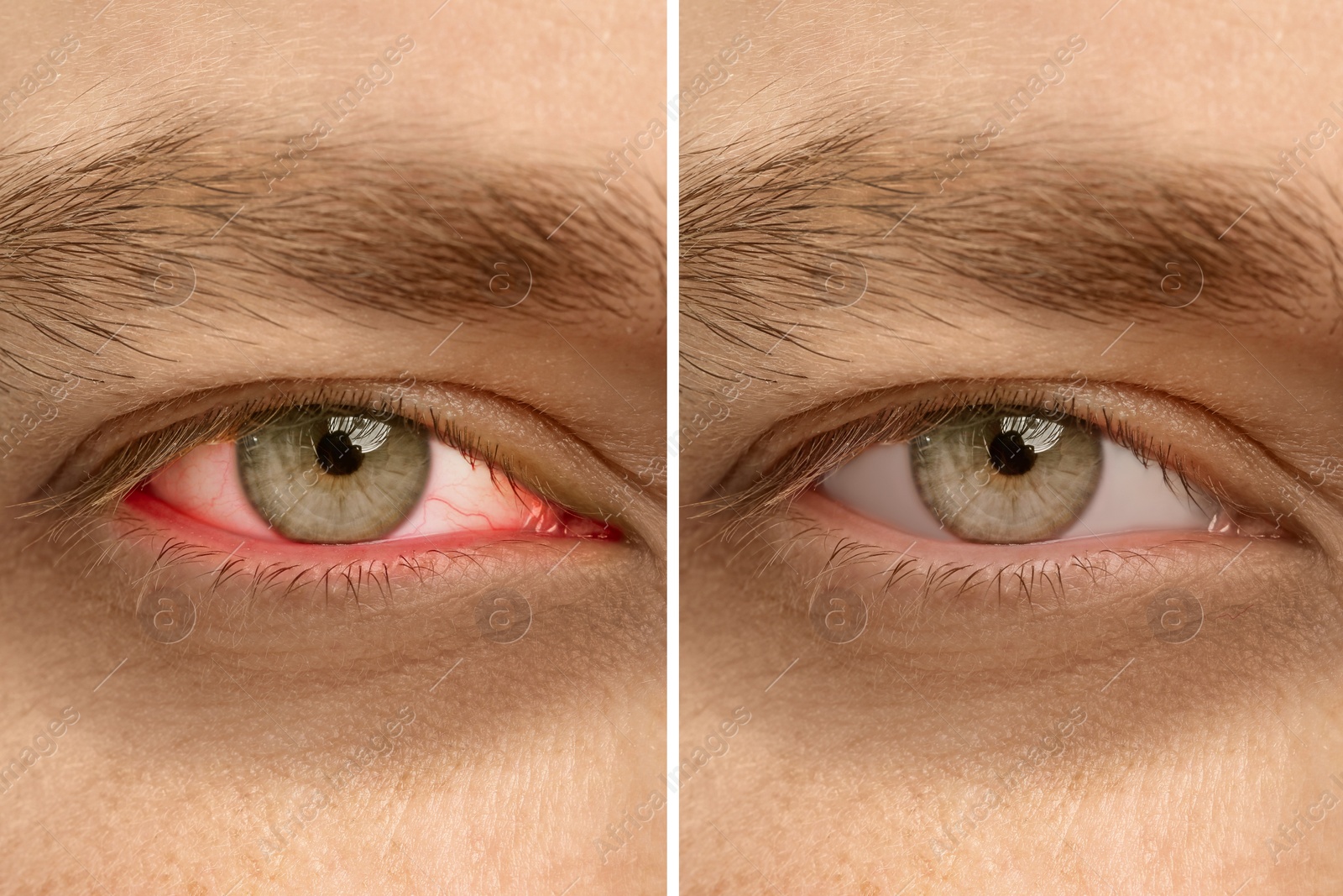 Image of Collage with photos of man before and after conjunctivitis treatment, closeup of eye