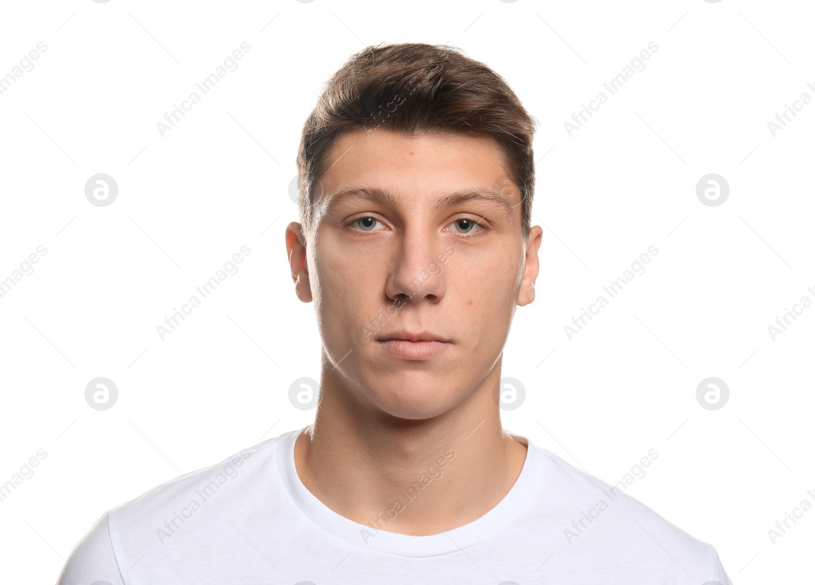 Photo of Teen guy with acne problem on white background