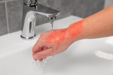 Photo of Woman holding burned hand under cold water indoors, closeup