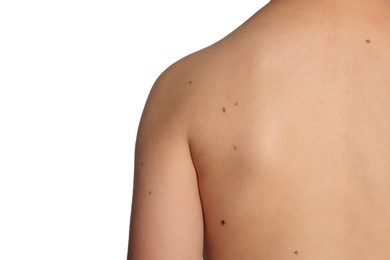 Photo of Closeup of boy's body with birthmarks on light grey background, back view. Space for text