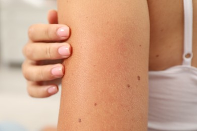 Closeup view of woman`s arm with birthmarks indoors