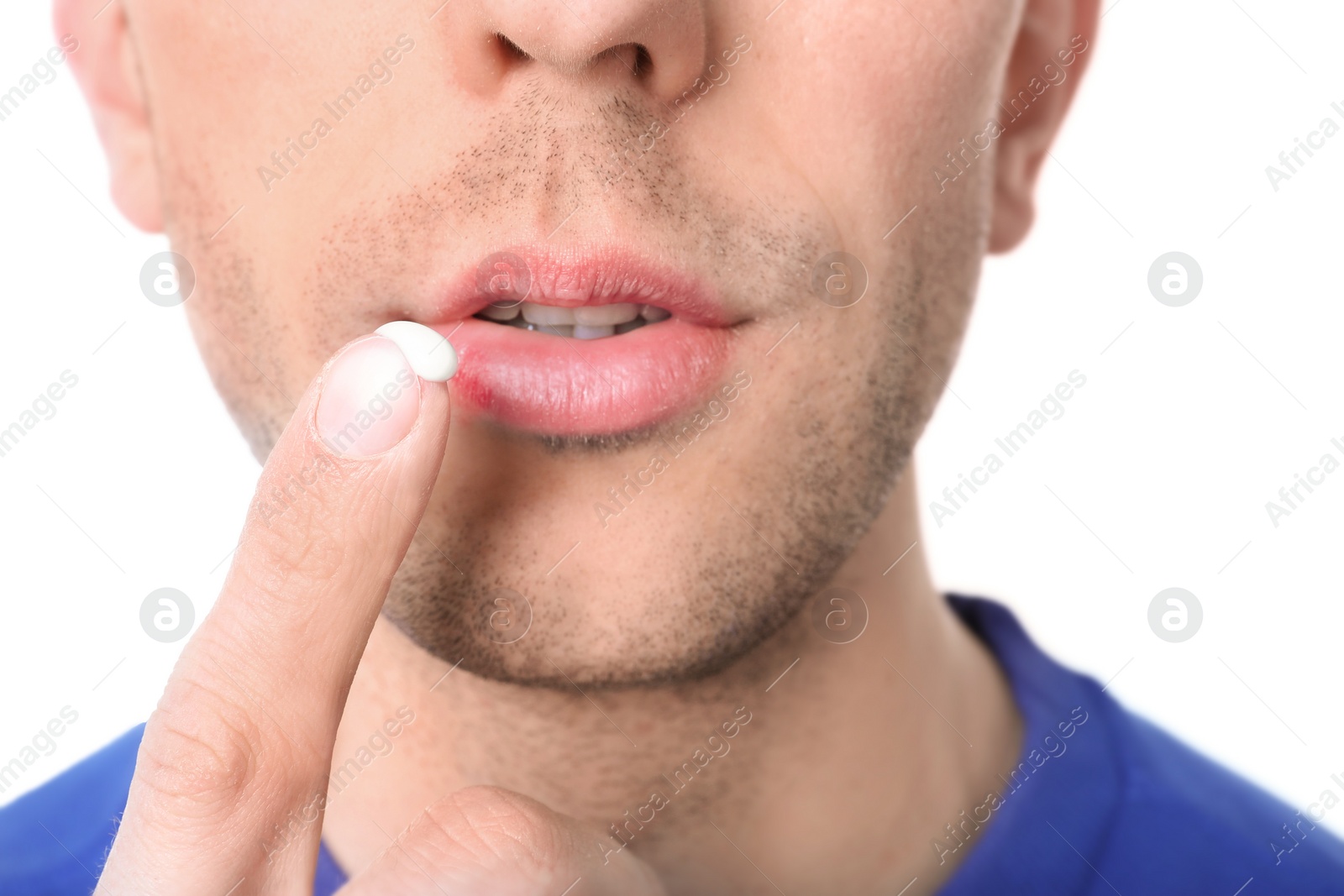 Photo of Young man applying cold sore cream on lips against white background, closeup