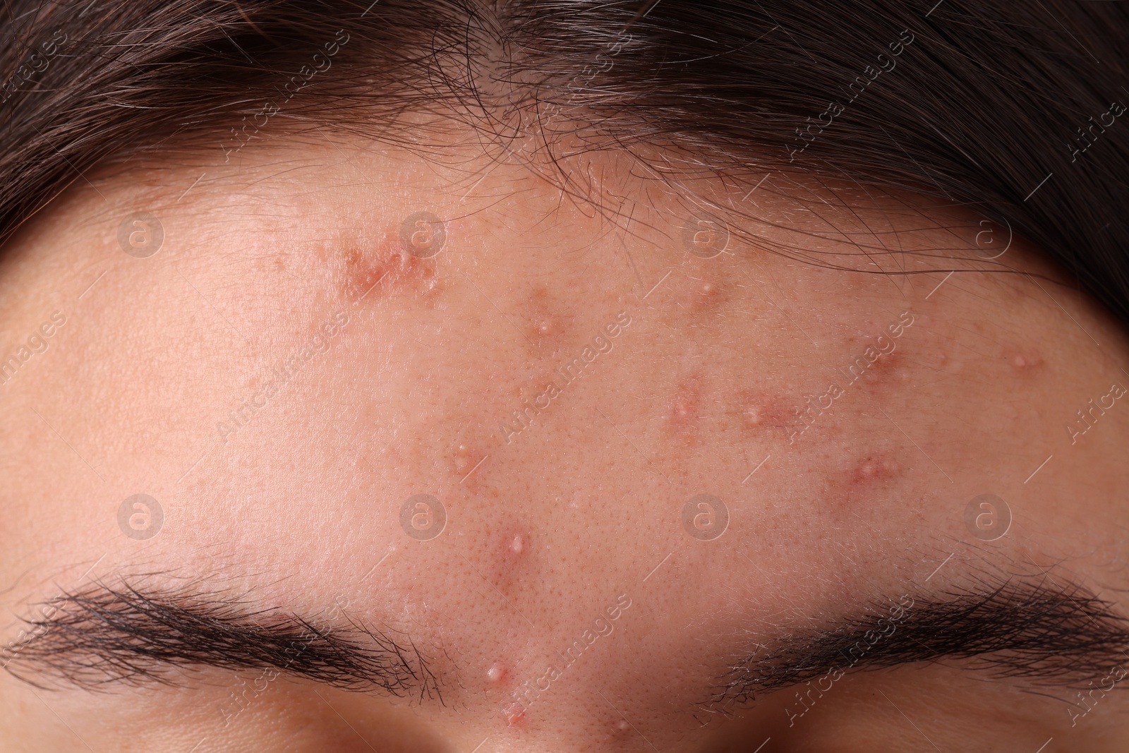 Photo of Young woman with acne problem, closeup view