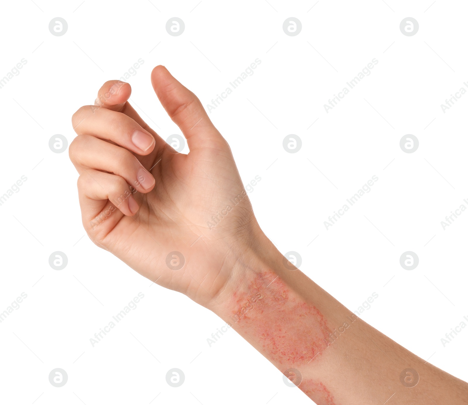 Image of Woman showing hand with dry skin on white background, closeup