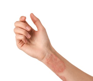 Woman showing hand with dry skin on white background, closeup