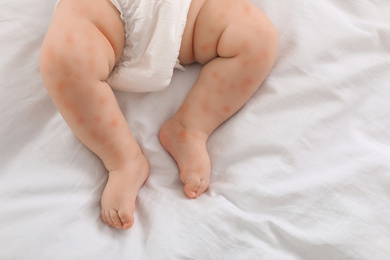 Image of Little child with red rash on bed, top view. Baby allergies