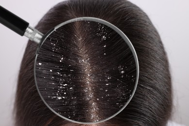 Woman suffering from dandruff on light background, closeup. View through magnifying glass on hair with flakes