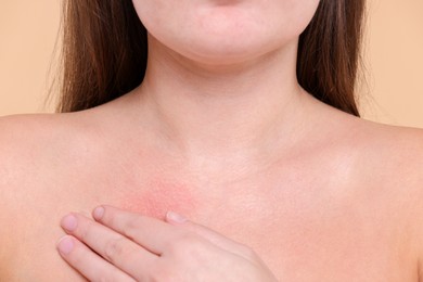 Closeup view of woman with reddened skin on her collarbone against beige background
