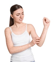 Woman with rash suffering from monkeypox virus on white background