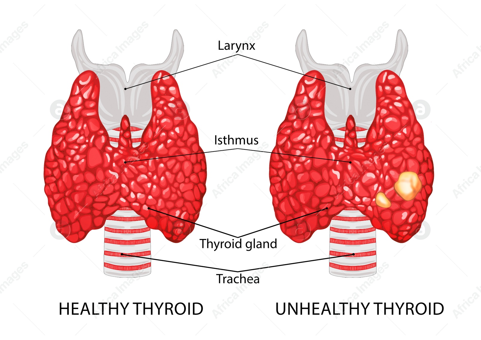 Illustration of  healthy and diseased thyroid on white background
