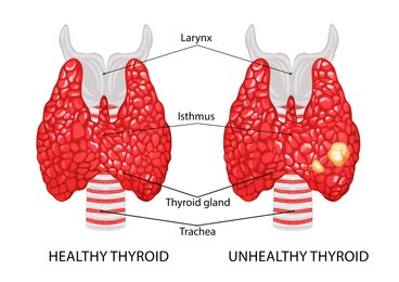 Illustration of  healthy and diseased thyroid on white background
