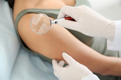 Photo of Dermatologist examining patient's birthmark with magnifying glass in clinic, closeup