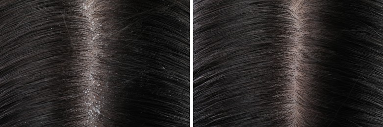 Woman showing hair before and after dandruff treatment, collage