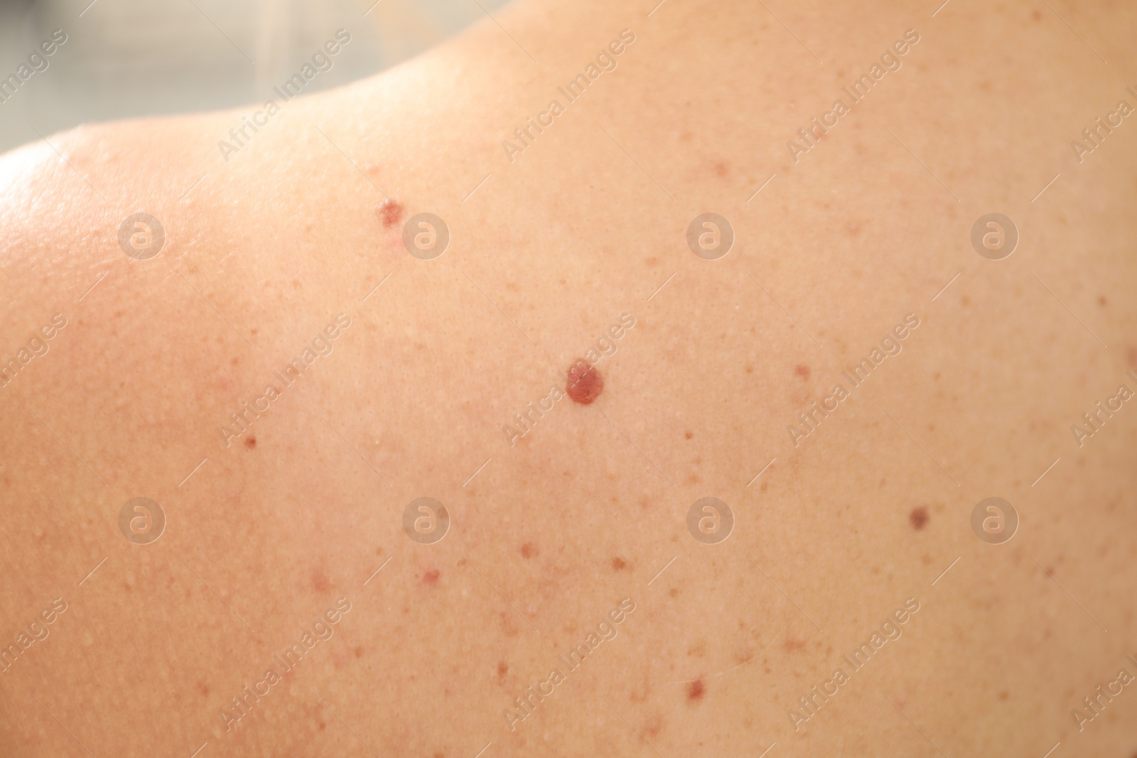 Photo of Closeup of woman's body with birthmarks as background