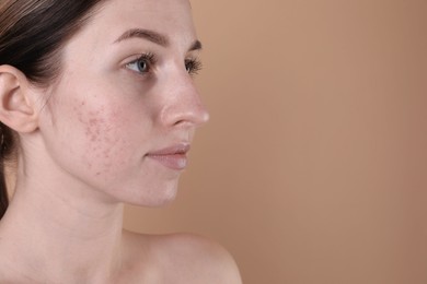 Young woman with acne problem on beige background. Space for text