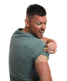 Man with sunburned skin on white background