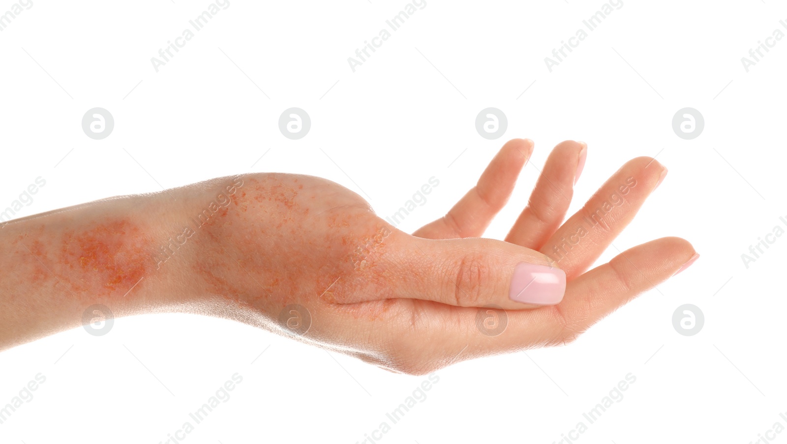 Image of Woman showing hand with dry skin on white background, closeup