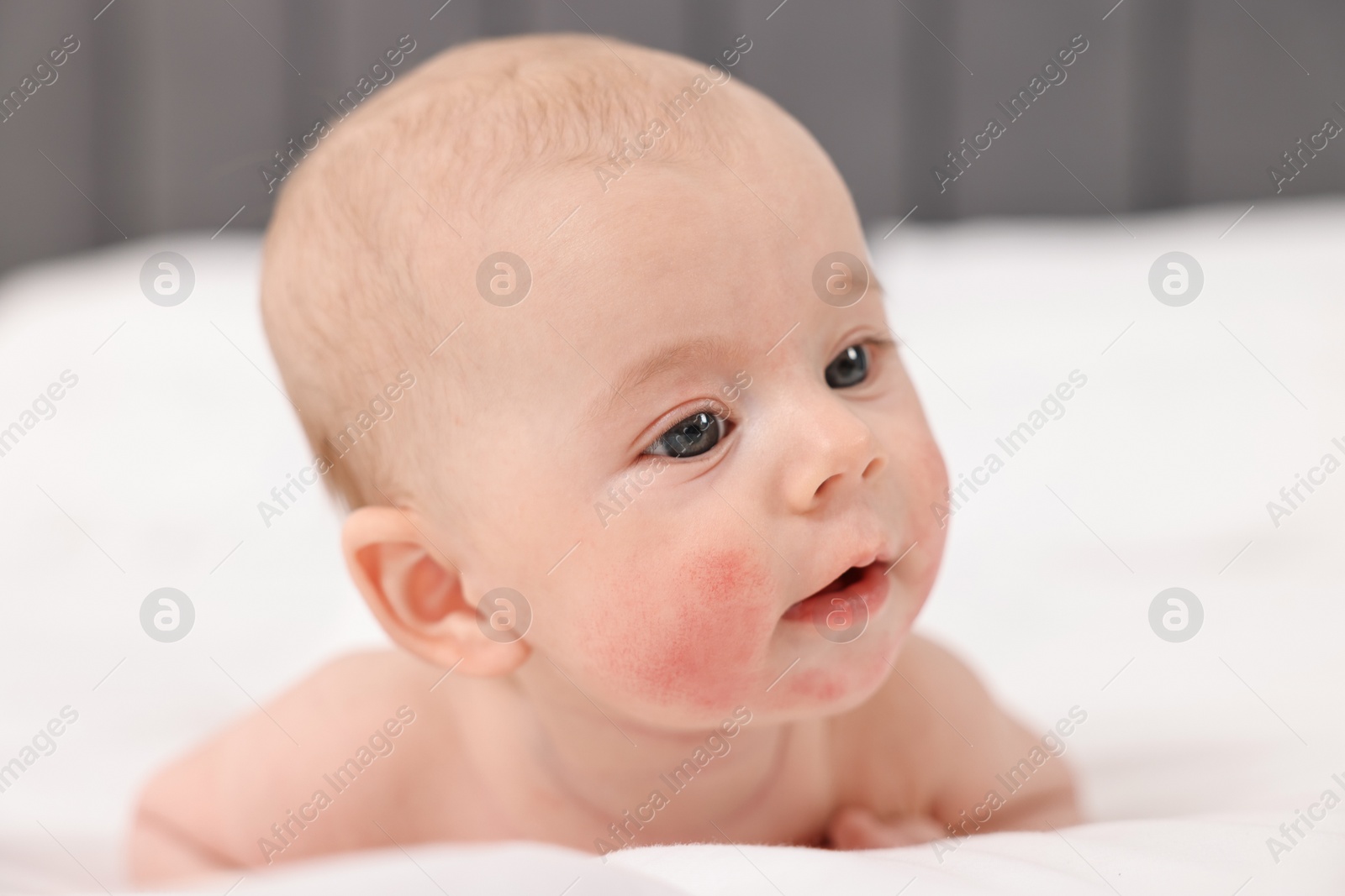 Photo of Cute little baby with allergic redness on cheeks lying on bed at home